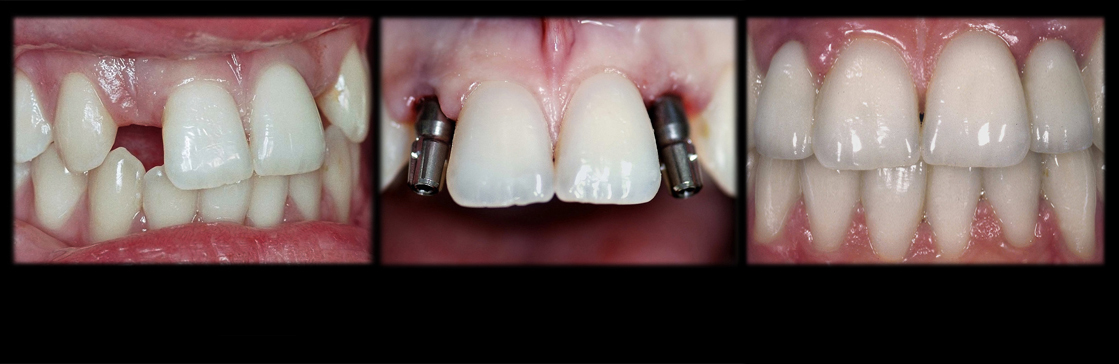 Anatomische Implantate Bilder Vorher Nachher